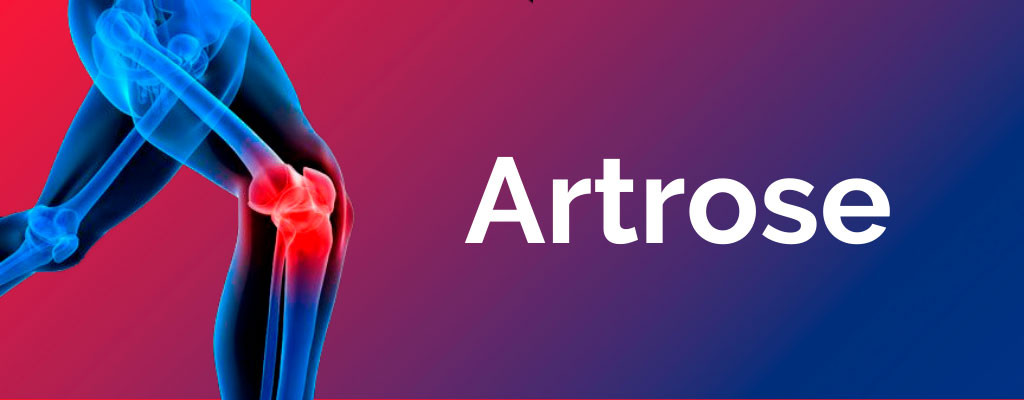 O que é artrose? Causas, tipos e tratamentos